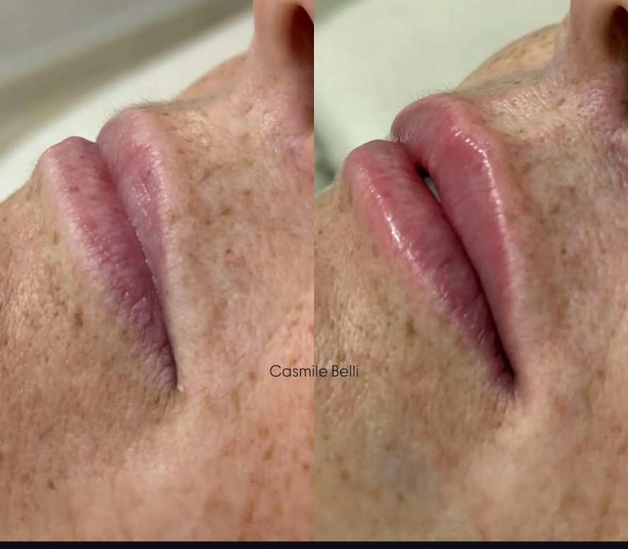 Antes e depois de preenchimento labial