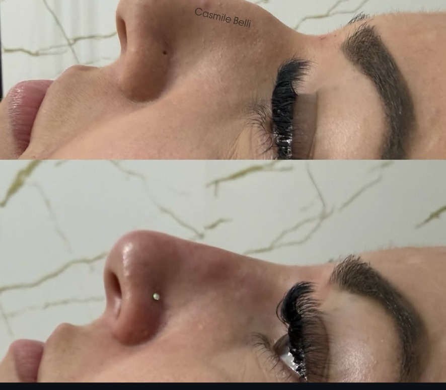 Antes e depois de harmonização do perfil e nariz