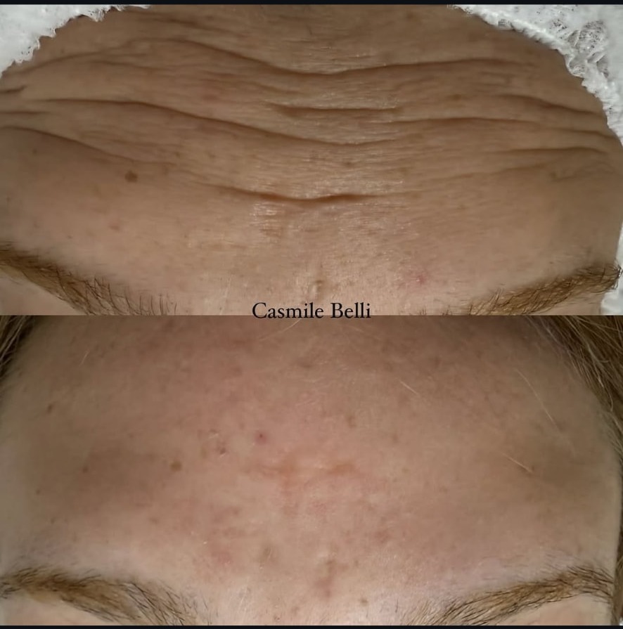 Antes e depois de toxina botulínica na testa