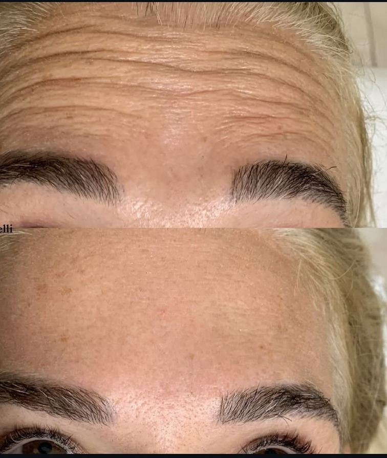 Antes e depois de toxina botulínica